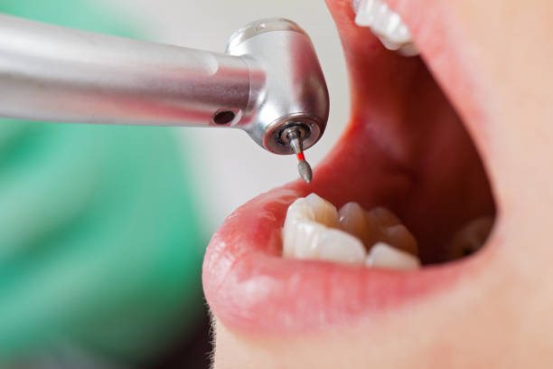 Best Emergency Wisdom Teeth Removal in Rapids, NY